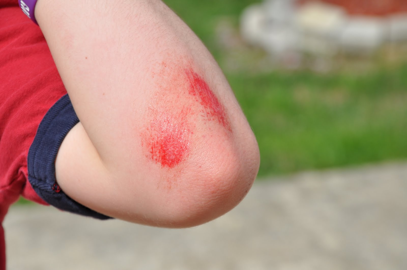 Minor injuries – cuts, grazes, bruises, splinters and nosebleeds